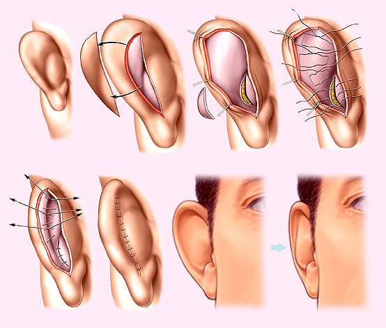 otoplastika