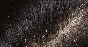 PRP терапия для волос - фото 2