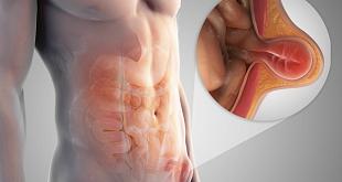 Лечение пупочной грыжи - фото 2