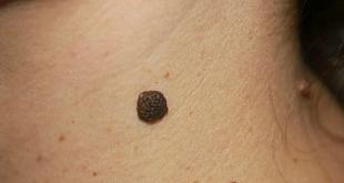 Лечение экземы - фото 2