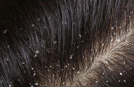 Причины возникновения перхоти и как ее лечить
