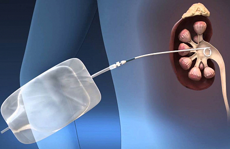 Замена нефростомы, кутанеостомы