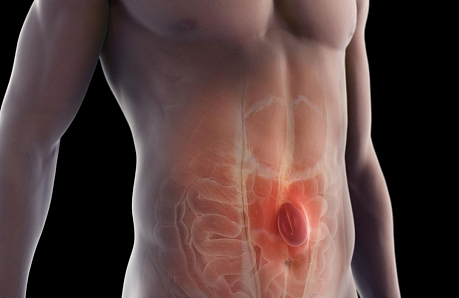 Амбулаторное лечение пупочной и паховой грыжи