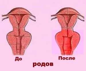 Опущение стенки влагалища после родов.