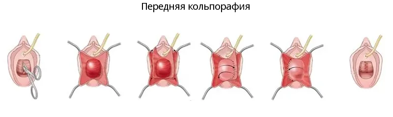 Опущение стенок влагалища: симптомы, лечение, коррекция | Клиника Частная врачебная практика в Челябинске